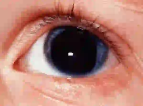 La Aniridia: Condición Rara del Ojo