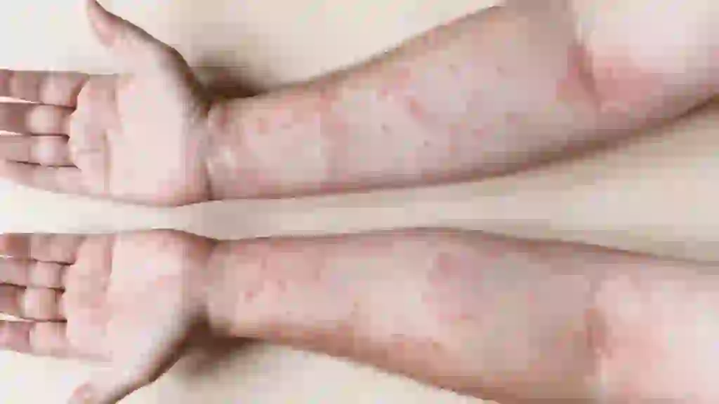 lupus 2