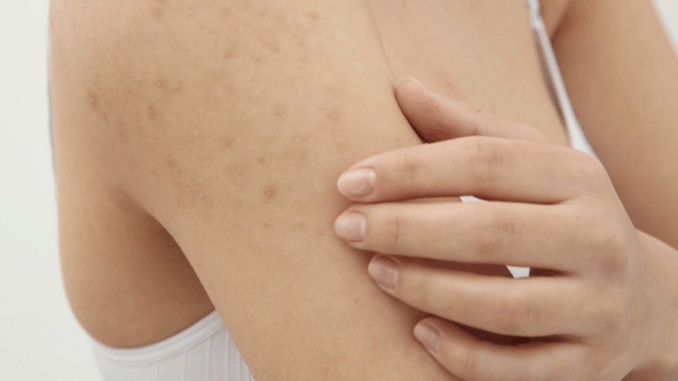 Doctor Descifra el Brote de Sarna: “Este Síntoma Debería Preocuparte”