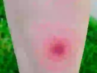 La enfermedad de Lyme en el punto de mira: por qué todos la buscan este verano de 2025