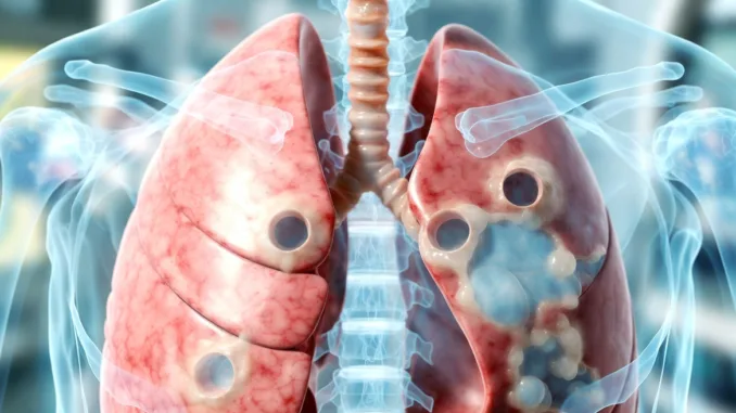 Fibrosis quística: causas, síntomas, diagnóstico y tratamientos actuales