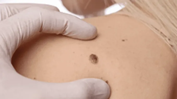 Localizan la célula que da origen al sarcoma de Ewing, un tumor infantil especialmente agresivo